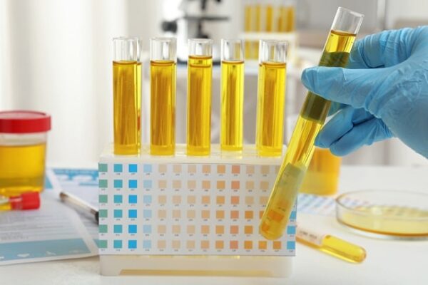 Uric Acid Urine Random