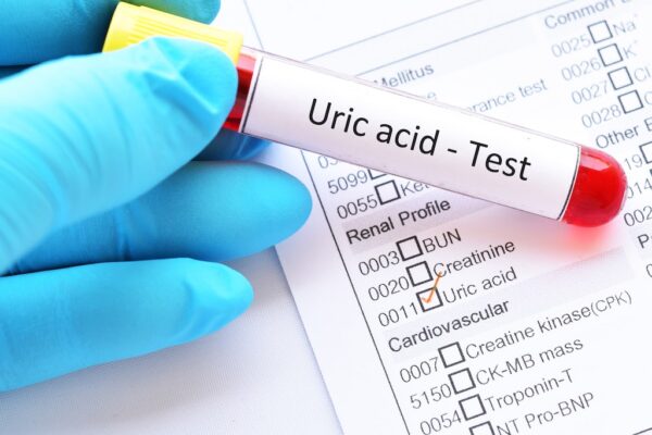 Uric Acid Serum