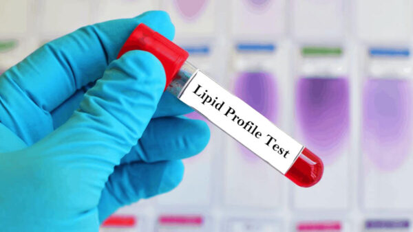 Lipid Profile Advance